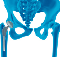 Fluoroscopic Guided Component Positioning