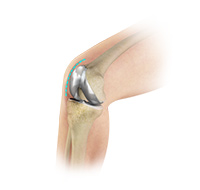 Outpatient Total Knee Replacement