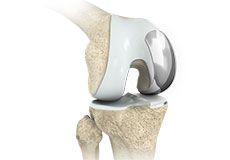 Partial Knee Replacement