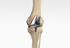 Revision Knee Replacement
