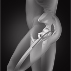 Anterior Hip Replacement