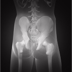 Outpatient Hip Surgery