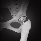 Outpatient Total Hip Replacement