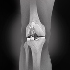 Partial Knee Replacement