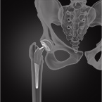 Total Hip Replacement