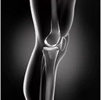 Total Knee Replacement