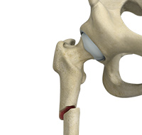 Subtrochanteric Hip Fracture