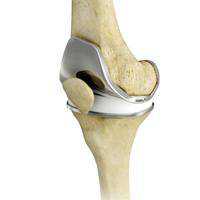 Total Knee Replacement